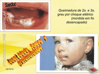 Queimadura de 2o. e 3o.
grau por choque elétrico
(mordida em fio
desencapado)
03/10/14 16
 