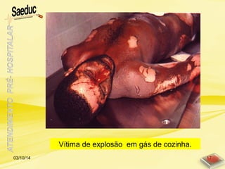 Vítima de explosão em gás de cozinha.
03/10/14 17
 