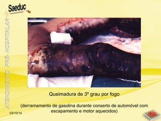 Queimadura de 3º grau por fogo
(derramamento de gasolina durante conserto de automóvel com
escapamento e motor aquecidos)03/10/14 18
 