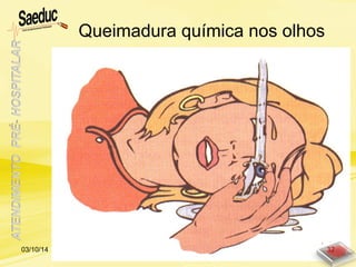 Queimadura química nos olhos
03/10/14 32
 