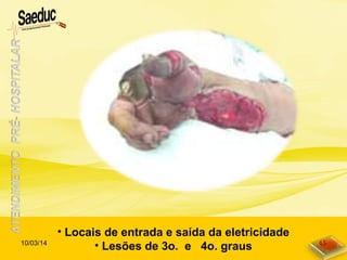 • Locais de entrada e saída da eletricidade
• Lesões de 3o. e 4o. graus10/03/14 45
 