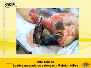Alta Tensão
Lesões musculares extensas = Rabdomiólise
10/03/14 48
 