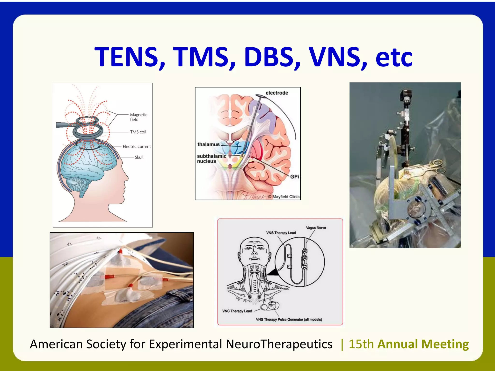 TENS, TMS, DBS, VNS, etc
American Society for Experimental NeuroTherapeutics | 15th Annual Meeting
 