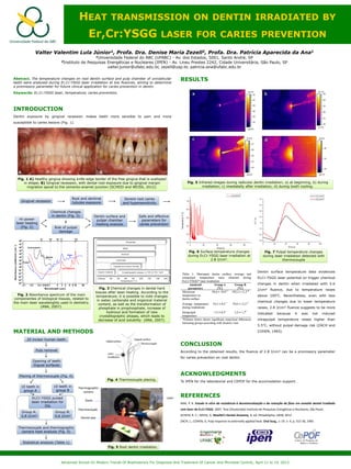 HEAT TRANSMISSION ON DENTIN IRRADIATED BY
Er,Cr:YSGG LASER FOR CARIES PREVENTION
Valter Valentim Lula Júnior1, Profa. Dra. Denise Maria Zezell2, Profa. Dra. Patrícia Aparecida da Ana1
1Universidade Federal do ABC (UFABC) - Av. dos Estados, 5001, Santo André, SP
2Instituto de Pesquisas Energéticas e Nucleares (IPEN) - Av. Lineu Prestes 2242, Cidade Universitária, São Paulo, SP
valter.junior@ufabc.edu.br, zezell@usp.br, patricia.ana@ufabc.edu.br
Advanced School On Modern Trends Of Biophotonics For Diagnosis And Treatment Of Cancer And Microbial Control, April 11 to 19, 2013
Abstract. The temperature changes on root dentin surface and pulp chamber of uniradicular
teeth were analysed during Er,Cr:YSGG laser irradiation at low fluences, aiming to determine
a promissory parameter for future clinical application for caries prevention in dentin.
Keywords: Er,Cr:YSGG laser, temperature, caries prevention.
INTRODUCTION
Dentin exposure by gingival recession makes teeth more sensible to pain and more
susceptible to caries lesions (Fig. 1).
MATERIAL AND METHODS
Fig. 1 A) Healthy gingiva showing knife-edge border of the free gingiva that is scalloped
in shape; B) Gingival recession, with dental root exposure due to gingival margin
migration apical to the cemento-enamel junction (SCHEID and WEISS, 2012).
RESULTS
CONCLUSION
According to the obtained results, the fluence of 2.8 J/cm² can be a promissory parameter
for caries prevention on root dentin.
ACKNOWLEDGMENTS
To IPEN for the laboratorial and CEPOF for the accomodation support.
REFERENCES
ANA, P. A. Estudo in vitro da resistência à desmineralização e da retenção de flúor em esmalte dental irradiado
com laser de Er,Cr:YSGG. 2007. Tese (Doutorado) Instituto de Pesquisas Energéticas e Nucleares, São Paulo.
SCHEID, R. C.; WEISS, G. Woelfel's Dental Anatomy. 8. ed. Philadelphia: LWW, 2012.
ZACH, L.; COHEN, G. Pulp response to externally applied heat. Oral Surg., v. 19, n. 4, p. 515-30, 1965
Gingival recession
Root and dentinal
tubules exposure
Severe root caries
and hypersensitivity
Hi-power
laser heating
(Fig. 2)
Chemical changes
in dentin (Fig. 3)
Risk of pulpal
damage
Dentin surface and
pulpar chamber
heating analysis
Safe and effective
parameters for
caries prevention
X
Fig. 2 Absorbance spectrum of the main
componentes of biological tissues, related to
the main laser wavelenghts used in dentistry.
(ANA, 2007).
Fig. 3 Chemical changes in dental hard
tissues after laser heating. According to the
temperature, it is possible to note changes
in water, carbonate and organical material
content, as well as the transformation of
phosphate in pirophosphate, increase of
hydroxyl and formation of new
crystallographic phases, which leads to
decrease of acid solubility (ANA, 2007).
20 incisor human teeth
Pulp removal
Opening of teeth
lingual surfaces
Placing of thermocouple (Fig. 4)
10 teeth in
group A
10 teeth in
group B
Group A:
2,8 J/cm2
Group B:
5,6 J/cm2
Er,Cr:YSGG pulsed
laser irradiation for
20s
Thermocouple and thermographic
camera heat analysis (Fig. 5)
Statistical analysis (Table 1)
Fig. 4 Thermocouple placing.
Fig. 5 Root dentin irradiation.
Fig. 5 Infrared images during radicular dentin irradiation; a) at beginning, b) during
irradiation; c) imediatelly after irradiation; d) during tooth cooling.
Fig. 6 Surface temperature changes
during Er,Cr:YSGG laser irradiation at
2.8 J/cm2.
Fig. 7 Pulpal temperature changes
during laser irradiation detected with
thermocouple
Dentin surface temperature data evidences
Er,Cr:YSGG laser potential on trigger chemical
changes in dentin when irradiated with 5.6
J/cm² fluence, due to temperature raises
above 100°C. Nevertheless, even with less
chemical changes due to lower temperature
raises, 2.8 J/cm² fluence suggests to be more
indicated because it was not induced
intrapulpal temperature raises higher than
5.5°C, without pulpal damage risk (ZACH and
COHEN, 1965).
Laser
Thermocouple
Thermographic
camera
Tooth
Dental wax
0 20 40 60 80 100
0.0
0.5
1.0
1.5
2.0
2.5
3.0
3.5
T(
o
C)
Time (s)
2.8 J/cm
2
5.6 J/cm
2
0 20 40 60 80
20
30
40
50
60
70
Temperature(
o
C)
Time (s)
2.8 J/cm
2
 