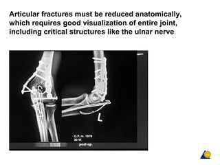 Surgical reduction techniques | PPT