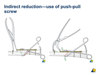 Surgical Reduction Techniques PPT Surgical Reduction Techniques PPT
