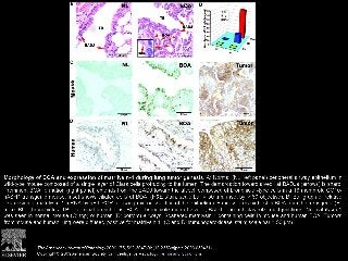 BOA and Lung Tumors Express Increased Levels of Matrilysin-1