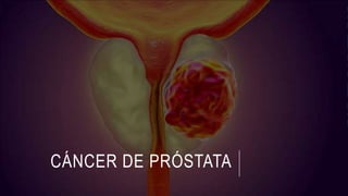CÁNCER DE PRÓSTATA
 