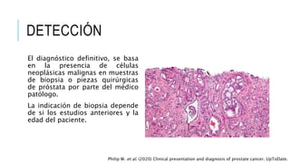DETECCIÓN
El diagnóstico definitivo, se basa
en la presencia de células
neoplásicas malignas en muestras
de biopsia o piezas quirúrgicas
de próstata por parte del médico
patólogo.
La indicación de biopsia depende
de si los estudios anteriores y la
edad del paciente.
Philip W. et al. (2020) Clinical presentation and diagnosis of prostate cancer. UpToDate.
 
