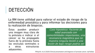 DETECCIÓN
La RM tiene utilidad para valorar el estado de riesgo de la
enfermedad prostática y para informar las decisiones para
la realización de biopsias.
Caso hipotético: Paciente de
edad avanzada con
comorbilidades importantes, una
resonancia magnética que no
muestra ninguna lesión o una
lesión de bajo riesgo podría ser
un argumento a renunciar a la
biopsia.
Éstas pueden producir
una imagen muy clara de
la próstata e indicar si el
cáncer se ha propagado
fuera de la próstata hasta
las vesículas seminales o
a otras estructuras
adyacentes.
Philip W. et al. (2020) Clinical presentation and diagnosis of prostate cancer. UpToDate.
 