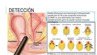 DETECCIÓN
El médico especialista (urólogo), debe indicar una biopsia de próstata,
dependiendo de la concentración de APE cuantitativo, un TR sospechoso o
ambos. Se debe considerar la expectativa de vida.
Generalmente procedemos a una biopsia
si:
• La esperanza de vida es de al menos
10 años (algunos médicos la indican si
la esperanza de vida es > 5 años).
• El PSA se eleva por encima del rango
para la cohorte de edad del paciente, o
• el PSA ha aumentado más de 0,75
ng/ml durante un año, o
• hay una palpación con respecto a la
anormalidad en el TR.
Realizar la BTR, guiada por
ultrasonido bajo sedación, con
valoración pre-quirúrgica o con
anestesia local, con técnica de doble
sextante, es decir, 6 cilindros de cada
lóbulo prostático, para un total de 12
cilindros.
Las complicaciones de la biopsia de
próstata (Infección, dolor, sangrado,
obstrucción urinaria) ocurren en hasta
el 2% de los hombres
Puede efectuarse vía transrectal o transperineal
guíada por el TR o por ecografía transrectal.
La PAAF es una alternativa con menos
complicaciones pero no puede evaluar el grado
histológico.
Ximing J. et al. (2020) Interpretation of prostate biopsy. UpToDate.
 