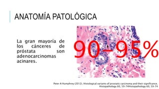 ANATOMÍA PATOLÓGICA
La gran mayoría de
los cánceres de
próstata son
adenocarcinomas
acinares.
90-95%
Peter A Humphrey (2012). Histological variants of prostatic carcinoma and their significance.
Histopathology 60, 59–74Histopathology 60, 59–74
 