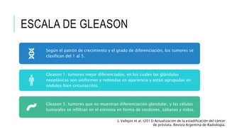 ESCALA DE GLEASON
J. Vallejos et al. (2013) Actualización de la estadificación del cáncer
de próstata. Revista Argentina de Radiología.
Según el patrón de crecimiento y el grado de diferenciación, los tumores se
clasifican del 1 al 5.
Gleason 1. tumores mejor diferenciados, en los cuales las glándulas
neoplásicas son uniformes y redondas en apariencia y están agrupadas en
nódulos bien circunscritos.
Gleason 5. tumores que no muestran diferenciación glandular, y las células
tumorales se infiltran en el estroma en forma de cordones, sábanas y nidos.
 
