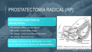 PROSTATECTOMÍA RADICAL (RP)
Sabiston. Tratado de Cirugía
REFERENCIAS ANATÓMICAS
IMPORTANTES
•Por delante: Plexo venoso dorsal
•Por arriba: Cuello de la vejiga
•Por debajo: Unión prostatomembranosa
•Por detrás: Pared del recto.
El plano correcto de disección se sitúa
justo detrás de la fascia de Denonvillers.
 
