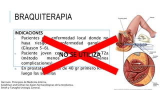 BRAQUITERAPIA
Colocación de semillas radiactivas bajo guía de US
transrectal.
Los implantes pueden ser:
• Permanentes (yodo 125 o paladio 103): entregan
una dosis total más elevada en comparación con los
implantes temporales.
•Temporales: entregan una dosis total más baja
INDICACIONES
I. Pacientes con enfermedad local donde no
haya riesgo de enfermedad ganglionar
(Gleason 5-6).
II. Paciente joven con APE <10 o T1-T2a
(método menos agresivo, menos
complicaciones).
III. En prostatas de mas de 40 gr primero RTU y
luego las semillas
Harrison. Principios de Medicina Interna,
Goodman and Gilman las bases farmacológicas de la terpéutica,
Smith y Tanagho Urología General.
NO SE UTILIZA
 