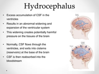 Hydrocephalus
• Excess accumulation of CSF in the
ventricles
• Results in an abnormal widening and
expansion of the ventricular system
• This widening creates potentially harmful
pressure on the tissues of the brain
• Normally, CSF flows through the
ventricles, and exits into cisterns
(reservoirs) at the base of the brain
• CSF is then reabsorbed into the
bloodstream
 