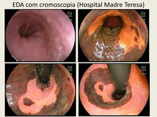 EDA com cromoscopia (Hospital Madre Teresa)
 