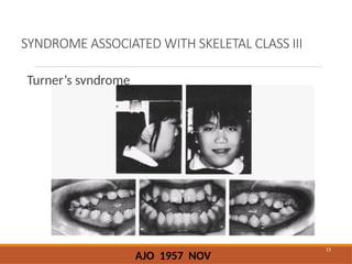 CLASS III MALOCCLUSION INTRO DEFINATION.pptx