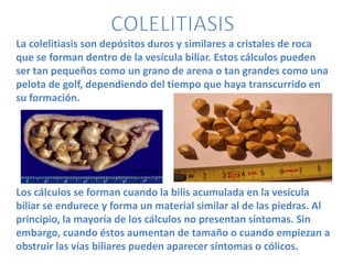 La colelitiasis son depósitos duros y similares a cristales de roca
que se forman dentro de la vesícula biliar. Estos cálculos pueden
ser tan pequeños como un grano de arena o tan grandes como una
pelota de golf, dependiendo del tiempo que haya transcurrido en
su formación.




Los cálculos se forman cuando la bilis acumulada en la vesícula
biliar se endurece y forma un material similar al de las piedras. Al
principio, la mayoría de los cálculos no presentan síntomas. Sin
embargo, cuando éstos aumentan de tamaño o cuando empiezan a
obstruir las vías biliares pueden aparecer síntomas o cólicos.
 
