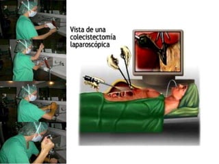 Colelitiasis y Colesistitis