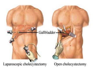 Colelitiasis y Colesistitis