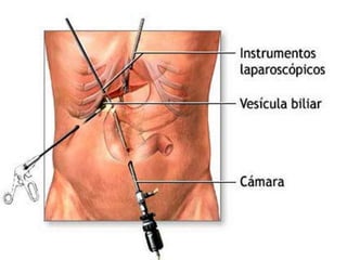 Colelitiasis y Colesistitis