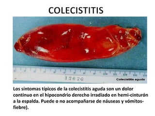 Los síntomas típicos de la colecistitis aguda son un dolor
continuo en el hipocondrio derecho irradiado en hemi-cinturón
a la espalda. Puede o no acompañarse de náuseas y vómitos-
fiebre).
 
