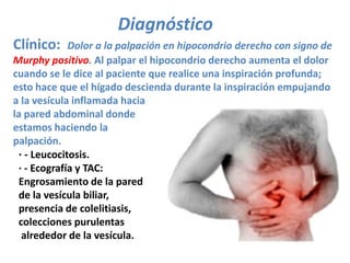 Diagnóstico
Clínico:     Dolor a la palpación en hipocondrio derecho con signo de
Murphy positivo. Al palpar el hipocondrio derecho aumenta el dolor
cuando se le dice al paciente que realice una inspiración profunda;
esto hace que el hígado descienda durante la inspiración empujando
a la vesícula inflamada hacia
la pared abdominal donde
estamos haciendo la
palpación.
 · - Leucocitosis.
 · - Ecografía y TAC:
 Engrosamiento de la pared
 de la vesícula biliar,
 presencia de colelitiasis,
 colecciones purulentas
  alrededor de la vesícula.
 