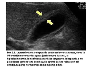 Eco. 1.6. La pared vesicular engrosada puede tener varias causas, como la
inflamación en colecistitis aguda (casi siempre litiásica), la
hipoalbuminemia, la insuficiencia cardiaca congestiva, la hepatitis, o no
patológicas como la falta de un ayuno óptimo para la realización del
estudio. La pared normal mide como máximo 3 mm.
 