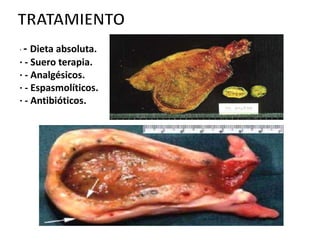 ·-  Dieta absoluta.
· - Suero terapia.
· - Analgésicos.
· - Espasmolíticos.
· - Antibióticos.
 