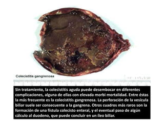 Sin tratamiento, la colecistitis aguda puede desembocar en diferentes
complicaciones, alguna de ellas con elevada morbi mortalidad. Entre éstas
la más frecuente es la colecistitis gangrenosa. La perforación de la vesícula
biliar suele ser consecuente a la gangrena. Otros cuadros más raros son la
formación de una fístula colecisto enteral, y el eventual paso de algún
cálculo al duodeno, que puede concluir en un íleo biliar.
 
