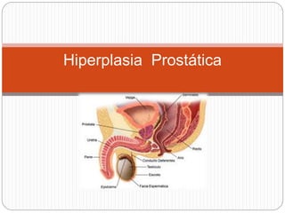 Hiperplasia Prostática
 