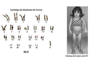Cariótipo da Síndrome de Turner




                                  Criança de 6 anos com ST.
 
