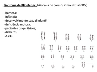 Síndrome de Klinefelter: trissomia no cromossomo sexual (XXY)

- homens;
- inférteis;
- desenvolvimento sexual infantil;
- deficiência motora;
- pacientes psiquiátricos;
- diabetes;
- A.V.C.
 