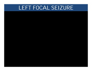 LEFT FOCAL SEIZURE
 