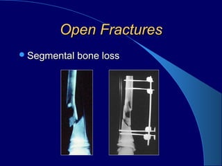 Open FracturesOpen Fractures
Segmental bone lossSegmental bone loss
 
