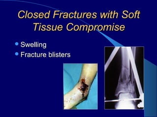 Closed Fractures with SoftClosed Fractures with Soft
Tissue CompromiseTissue Compromise
SwellingSwelling
Fracture blistersFracture blisters
 