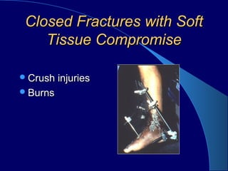 Closed Fractures with SoftClosed Fractures with Soft
Tissue CompromiseTissue Compromise
Crush injuriesCrush injuries
BurnsBurns
 