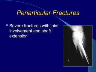 Periarticular FracturesPeriarticular Fractures
Severe fractures with jointSevere fractures with joint
involvement and shaftinvolvement and shaft
extensionextension
 