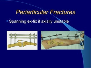 Periarticular FracturesPeriarticular Fractures
• Spanning ex-fix if axially unstableSpanning ex-fix if axially unstable
 