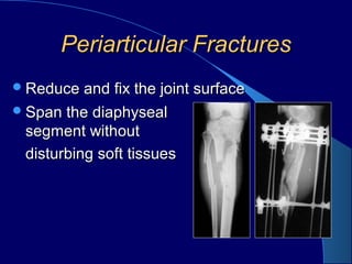 Periarticular FracturesPeriarticular Fractures
Reduce and fix the joint surfaceReduce and fix the joint surface
Span the diaphysealSpan the diaphyseal
segment withoutsegment without
disturbing soft tissuesdisturbing soft tissues
 