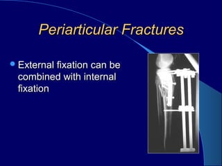 Periarticular FracturesPeriarticular Fractures
External fixation can beExternal fixation can be
combined with internalcombined with internal
fixationfixation
 