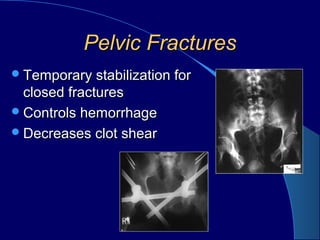 Pelvic FracturesPelvic Fractures
Temporary stabilization forTemporary stabilization for
closed fracturesclosed fractures
Controls hemorrhageControls hemorrhage
Decreases clot shearDecreases clot shear
 