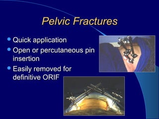 Pelvic FracturesPelvic Fractures
Quick applicationQuick application
Open or percutaneous pinOpen or percutaneous pin
insertioninsertion
Easily removed forEasily removed for
definitive ORIFdefinitive ORIF
 