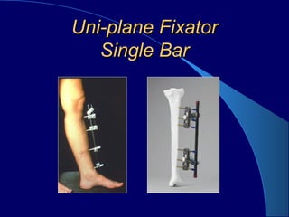 Uni-plane FixatorUni-plane Fixator
Single BarSingle Bar
 