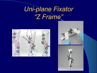 Uni-plane FixatorUni-plane Fixator
“Z Frame”“Z Frame”
 