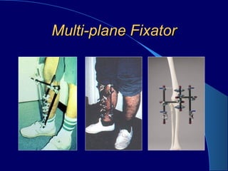 Multi-plane FixatorMulti-plane Fixator
 