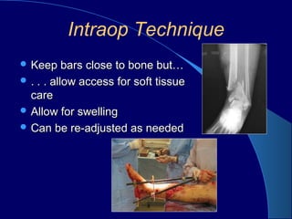 Intraop Technique
 Keep bars close to bone but…Keep bars close to bone but…
 . . . allow access for soft tissue. . . allow access for soft tissue
carecare
 Allow for swellingAllow for swelling
 Can be re-adjusted as neededCan be re-adjusted as needed
 