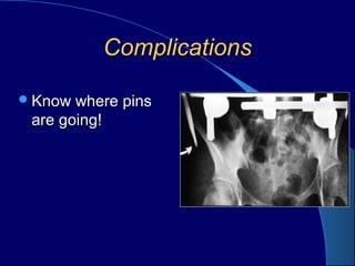 ComplicationsComplications
Know where pinsKnow where pins
are going!are going!
 
