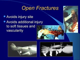 Open FracturesOpen Fractures
Avoids injury siteAvoids injury site
Avoids additional injuryAvoids additional injury
to soft tissues andto soft tissues and
vascularityvascularity
 